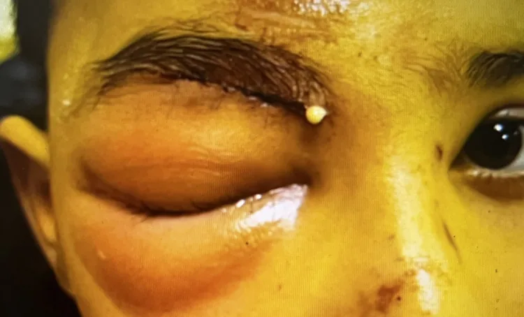 Celulite pré-septal orbitária: Caso clínico pediátrico mostrando eritema e edema intensos da pálpebra direita (sem proptose)