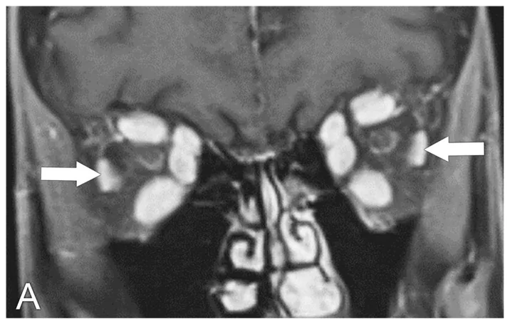 甲状腺眼症の冠状断T1強調造影MRI：両眼外眼筋肥厚
