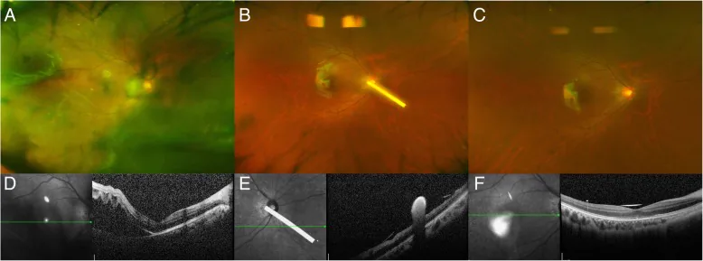 Décollement de rétine rhegmatogène associé à une dermatite atopique (photographie grand angle préopératoire et OCT)