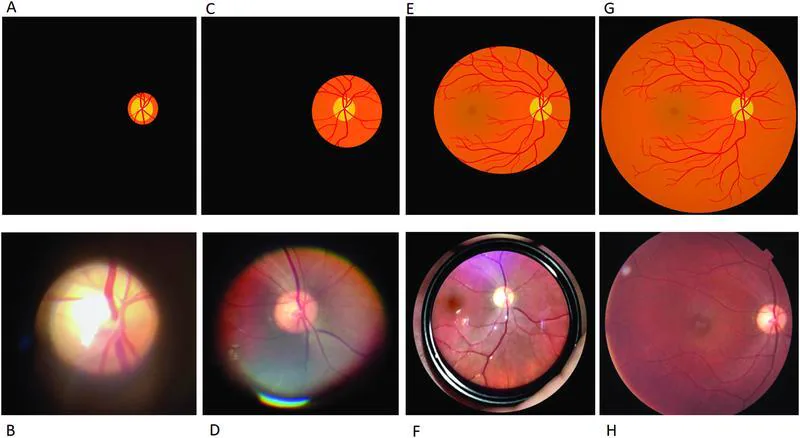 直像鏡・PanOptic・20D倒像鏡・網膜写真による眼底観察の比較（模式図と臨床写真）