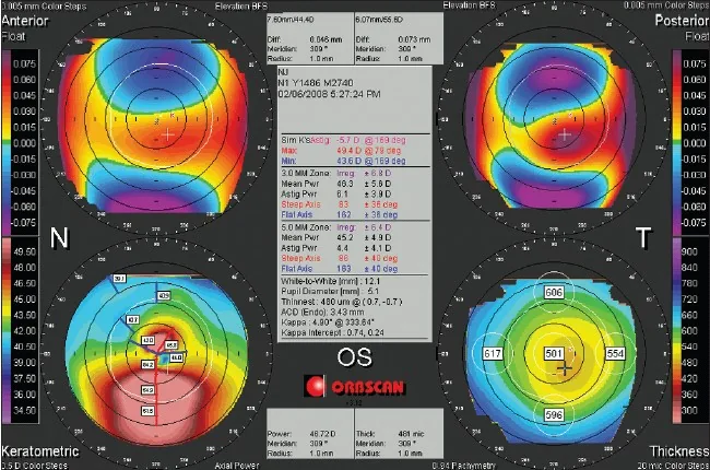 Orbscan IIスキャニングスリット・トポグラファーによるクアッドマップ（前面エレベーション・後面エレベーション・角膜屈折力・角膜厚）
