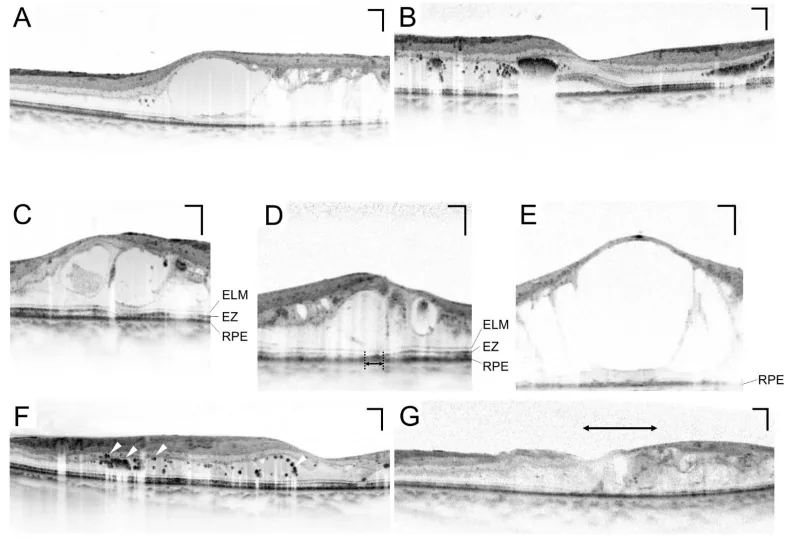 糖尿病黄斑浮腫のOCT断面像。嚢胞様黄斑浮腫（CME）と漿液性網膜剥離（SRD）のパターンを示す。本文「3. 検査方法」の項で扱う黄斑浮腫のOCT定量評価に対応する。