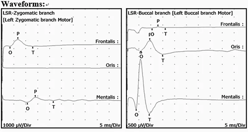 คลื่นไฟฟ้ากล้ามเนื้อแสดงการตอบสนองการแพร่กระจายด้านข้าง (lateral spreading response) ในภาวะเกร็งครึ่งหน้า (hemifacial spasm) การตอบสนองที่ผิดปกติจากกล้ามเนื้อหน้าผากและกล้ามเนื้อคางเมื่อกระตุ้นแขนงโหนกแก้มและแขนงแก้ม