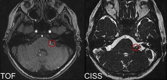MRI (TOF และ CISS) ของผู้ป่วยที่มีอาการกระตุกครึ่งหน้า หลอดเลือดแดง cerebellar inferior posterior (PICA) กดทับบริเวณ root exit zone (REZ) ของเส้นประสาทใบหน้า (วงกลมสีแดง)