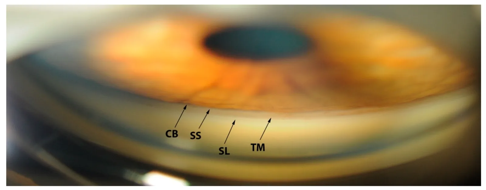 Gonioscopic photograph showing Schwalbe's line, trabecular meshwork, scleral spur, and ciliary body band
