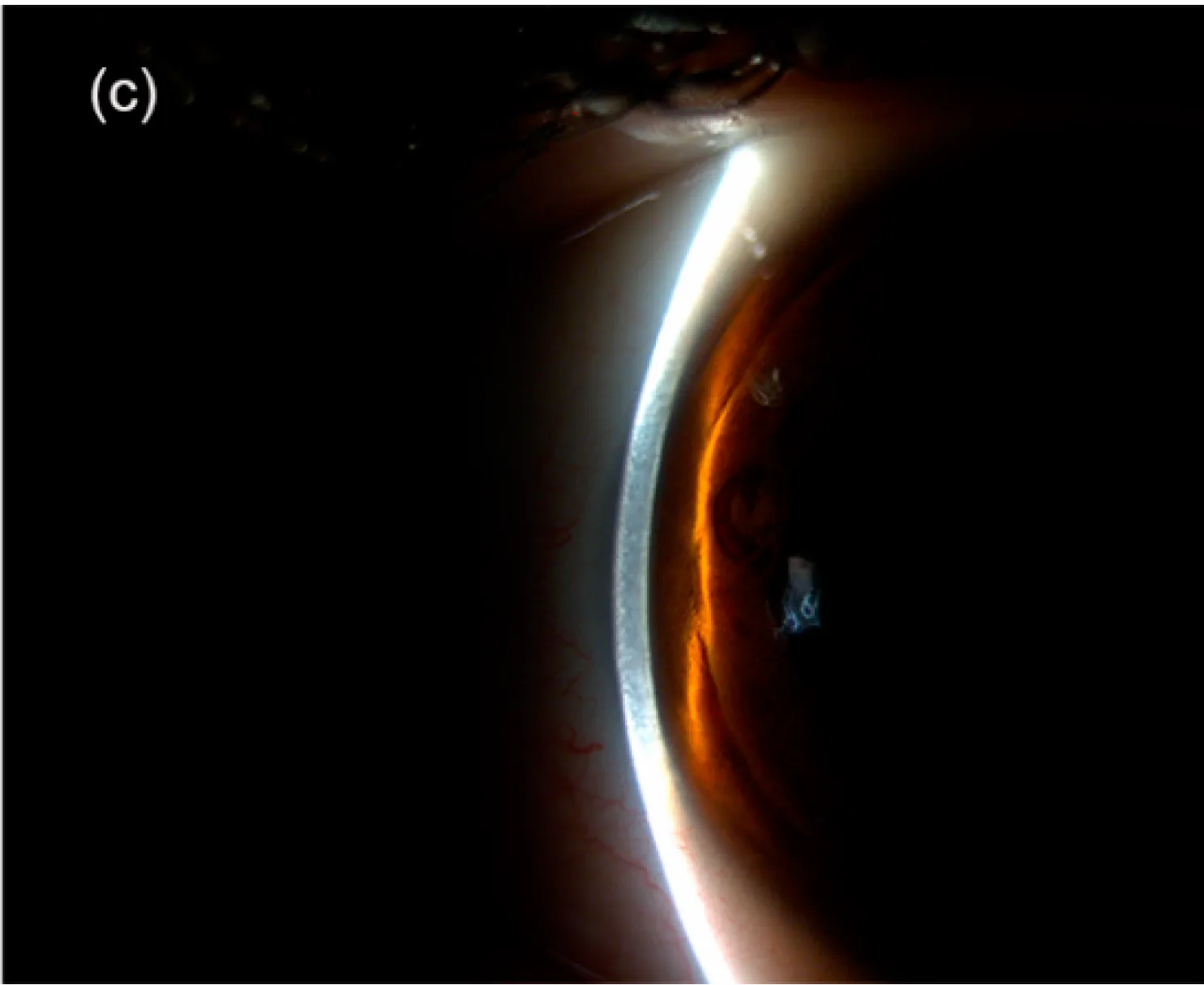 Slit-lamp photograph showing peripheral anterior chamber depth assessment with the van Herick method