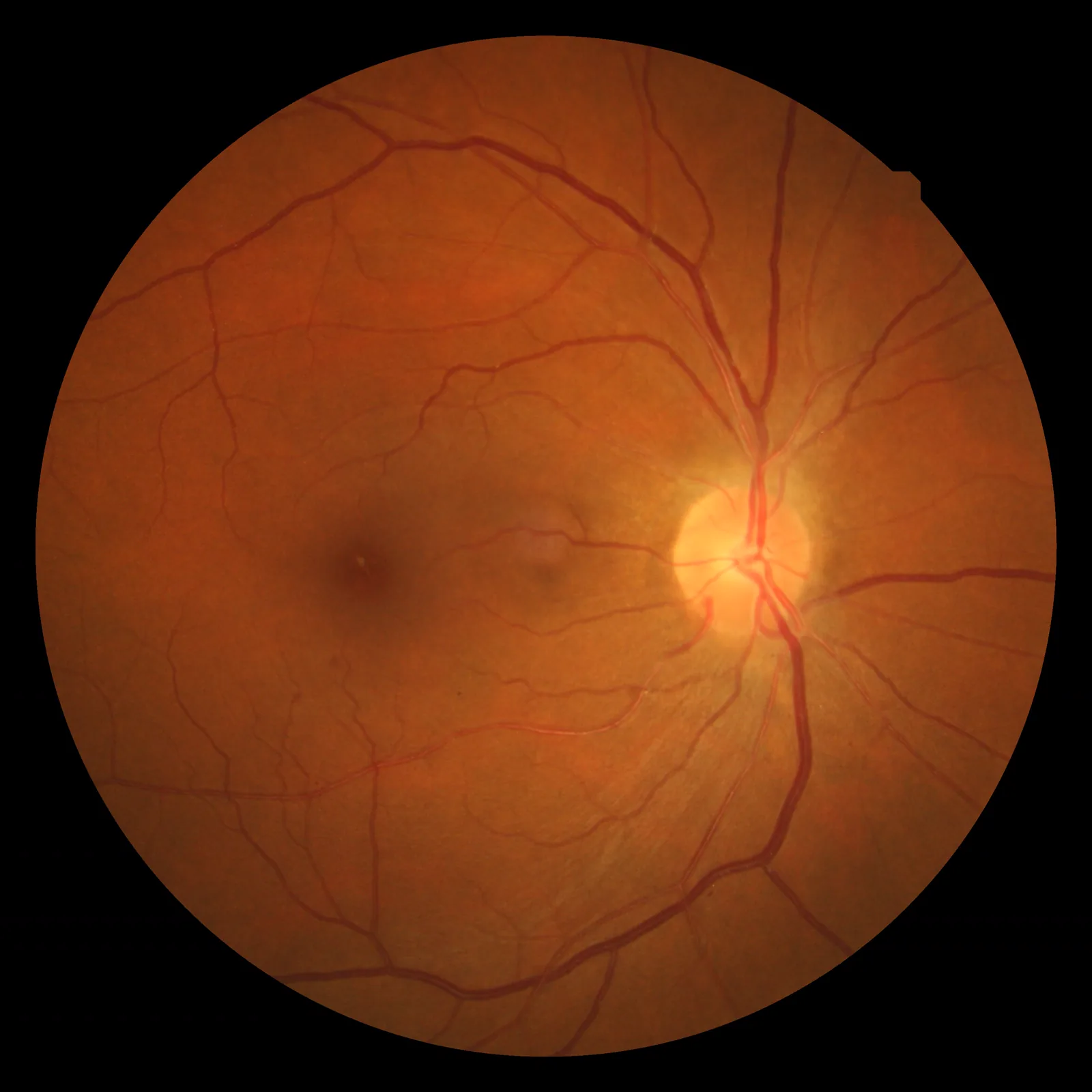 عکس فوندوس نشان‌دهنده تغییرات فوندوس هیپرتانسیو: پدیده تقاطع شریانی-وریدی و تنگ شدن شریانچه‌ها