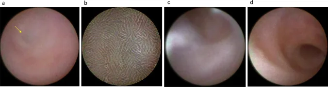 涙道内視鏡による鼻涙管内腔像（閉塞部と正常粘膜）