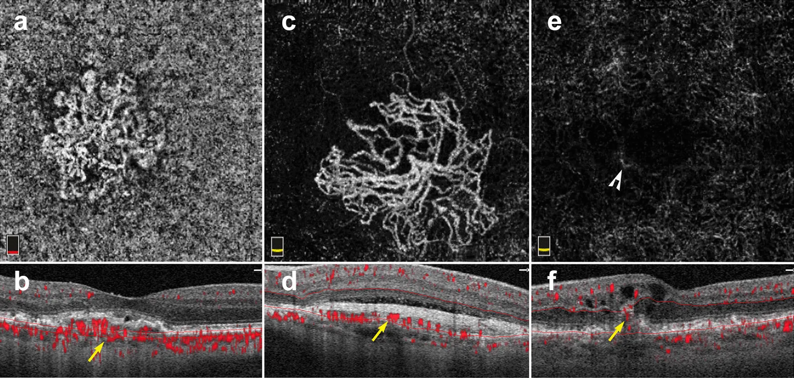 OCTA En-face-Bilder und B-Scans von drei Arten der makulären Neovaskularisation (MNV) bei exsudativer AMD