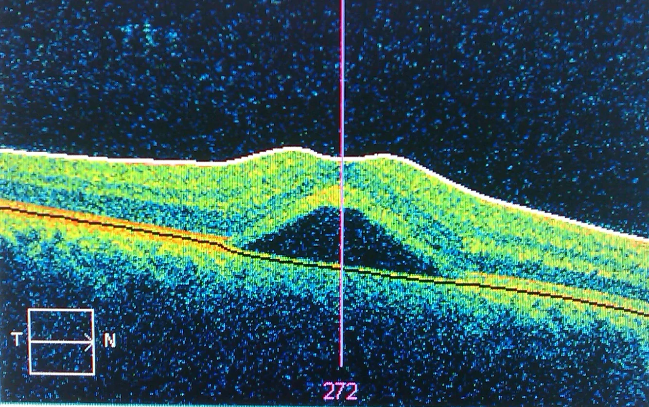 Imagen de tomografía de coherencia óptica (OCT) de coriorretinopatía serosa central (CSC) que ocurre comúnmente durante el embarazo