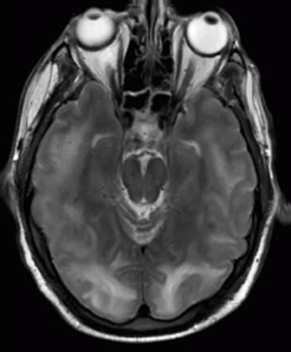 Imagen de RM craneal FLAIR de encefalopatía posterior reversible (PRES) asociada a preeclampsia