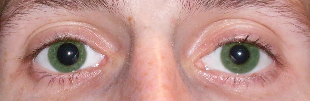 瞳孔不同（anisocoria）の臨床写真。左右の瞳孔径の不均等を示す。