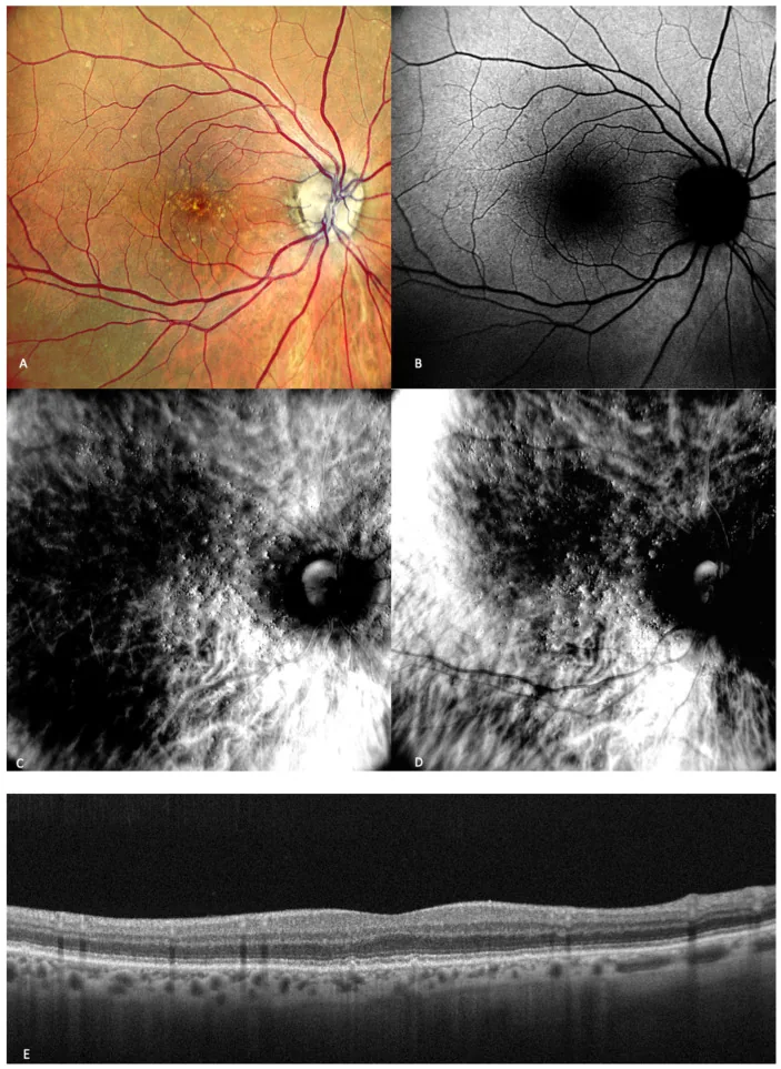 Image multimodale du fond d'œil d'une dégénérescence maculaire liée à l'âge précoce (petits et moyens drusen)