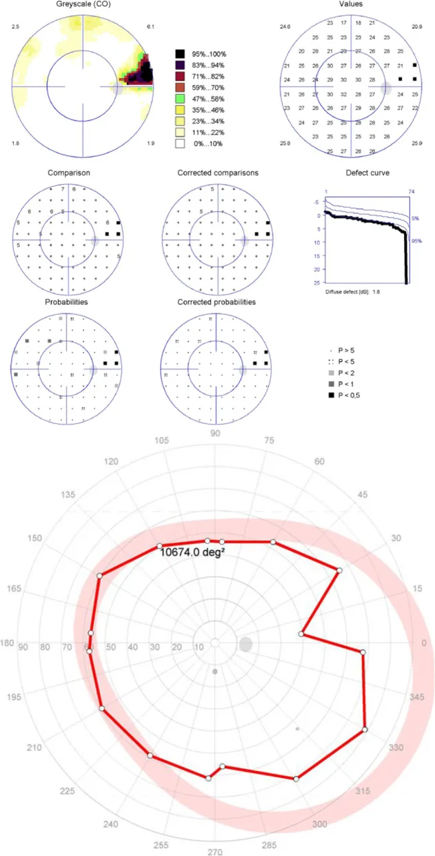 Déficit localisé du champ visuel dans le glaucome (champ visuel statique central et champ visuel dynamique périphérique)