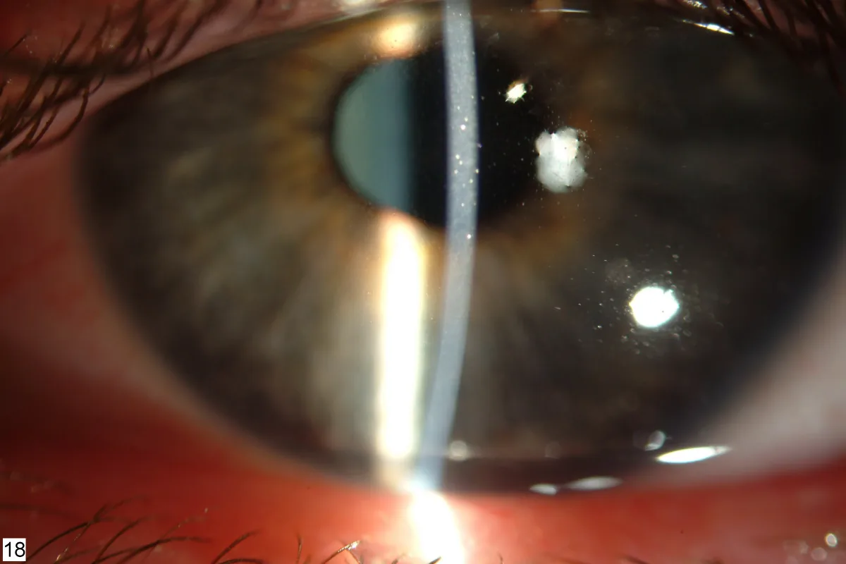前眼部細隙灯写真。角膜に点状の上皮下混濁（点状表層角膜症）が散在している所見