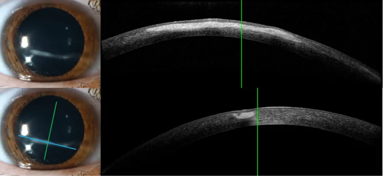 細隙灯顕微鏡による角膜前眼部検査とAS-OCTの対応像