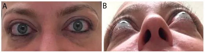 Endokrine Orbitopathie: Farbfoto der äußeren Augenregion mit Ober- und Unterlidretraktion und Exophthalmus