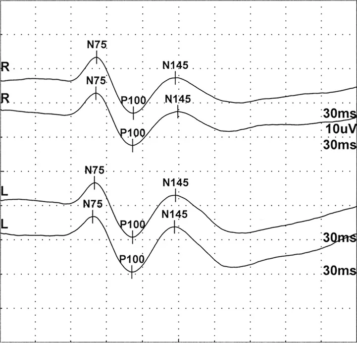 正常VEP波形：両眼のN75・P100・N145成分（パターン反転刺激）
