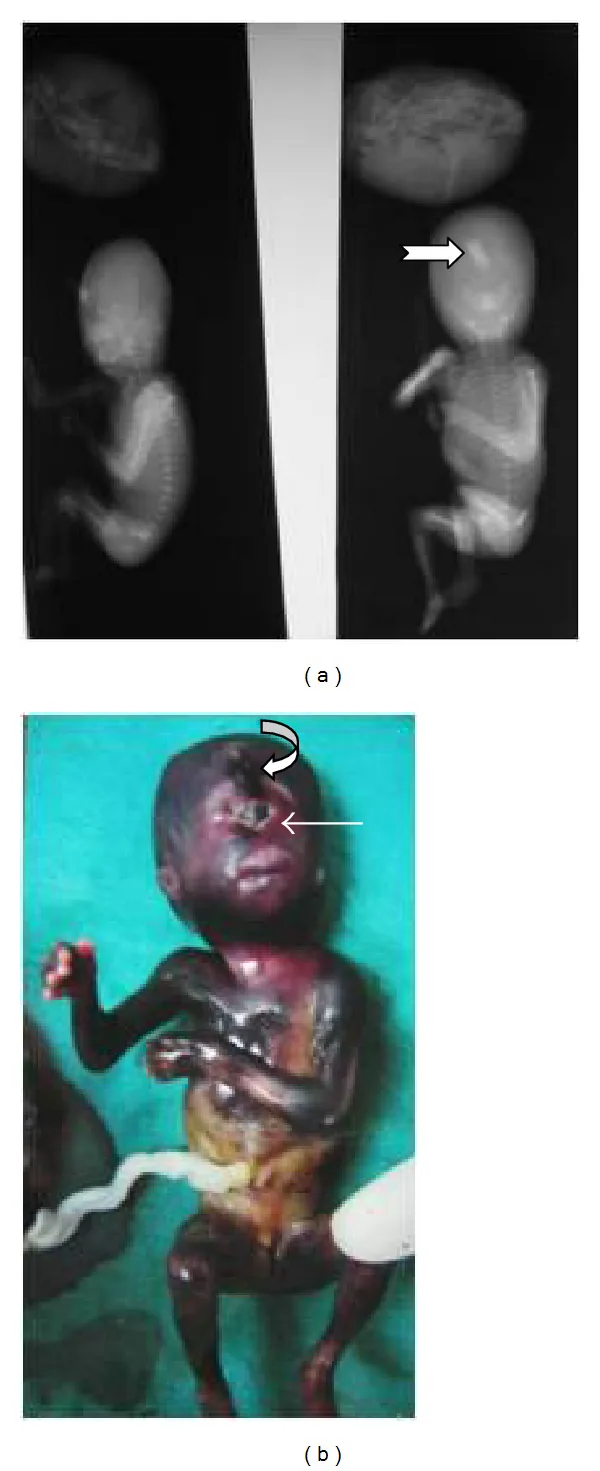 単眼症の標本写真とX線像