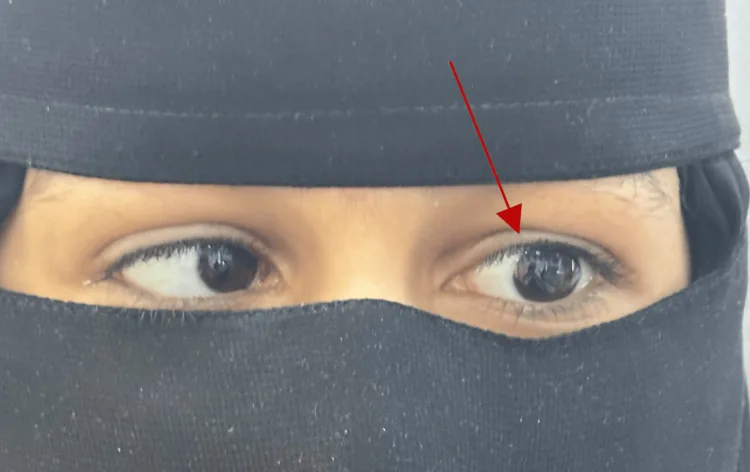 デュアン後退症候群の左眼外転障害