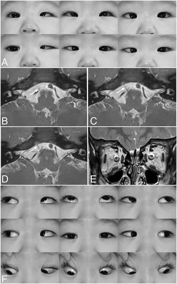デュアン症候群の左眼で、外転制限と内転時の眼裂狭小化を示す眼球運動写真