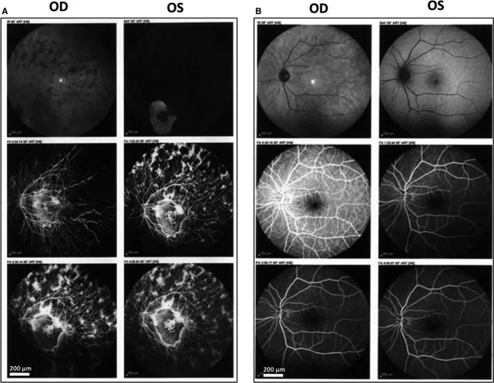 レーバー先天黒内障の眼底写真