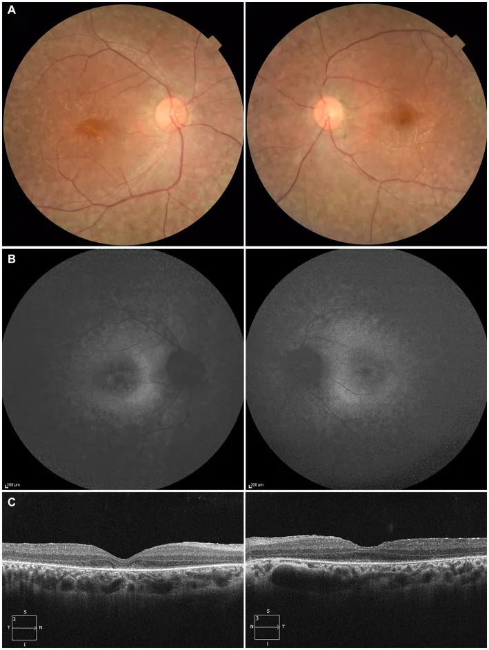 Photographies du fond d'œil, autofluorescence du fond d'œil et OCT des deux yeux d'un patient atteint d'amaurose congénitale de Leber, montrant des altérations de l'épithélium pigmentaire rétinien et des dommages à la rétine externe.