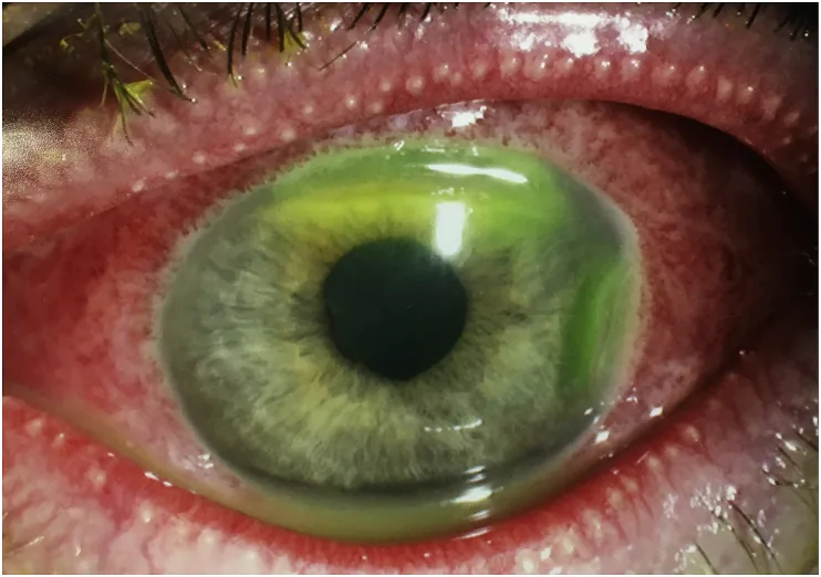 新生児結膜炎の細隙灯写真