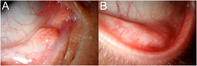 眼窩脂肪皮様腫の臨床写真