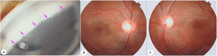 Hallazgos gonioscópicos y fotografías de fondo de ojo de ambos ojos en glaucoma congénito primario. Muestra inserción anterior del iris y excavación aumentada del disco óptico.