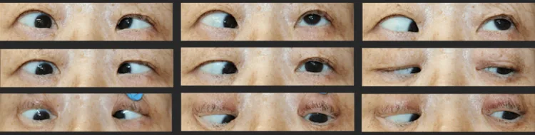ภาพถ่ายการเคลื่อนไหวของลูกตาที่แสดงภาวะตาเหล่คงที่ (strabismus fixus ในภาวะสายตาสั้นรุนแรง) โดยตาขวาเบี่ยงลงด้านใน และจำกัดการกลอกตาออกด้านนอกและขึ้นด้านบน