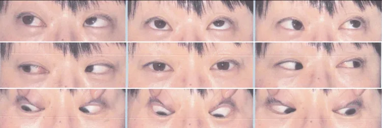 斜視の9方向眼位写真で、右眼の上転制限と眼位ずれを示す