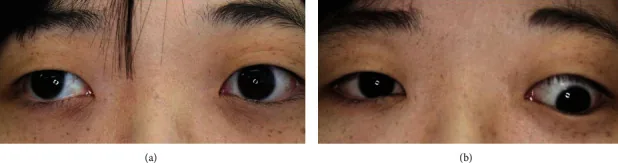 上下斜視の臨床写真。固視条件で上下の眼位ずれが変化している。