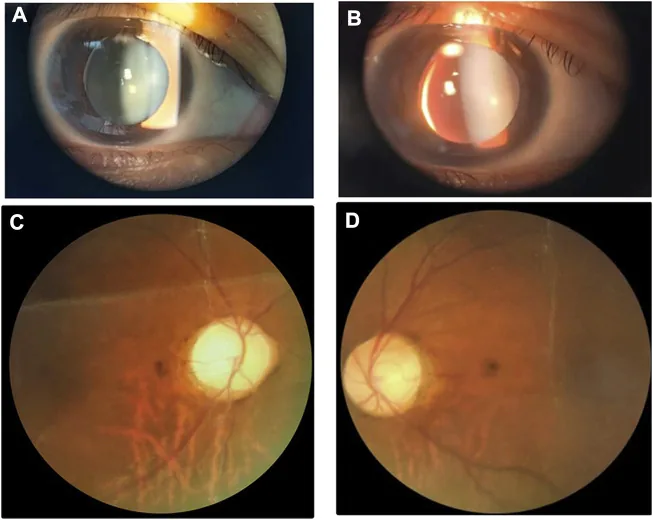 Weill-Marchesani syndrome ocular findings