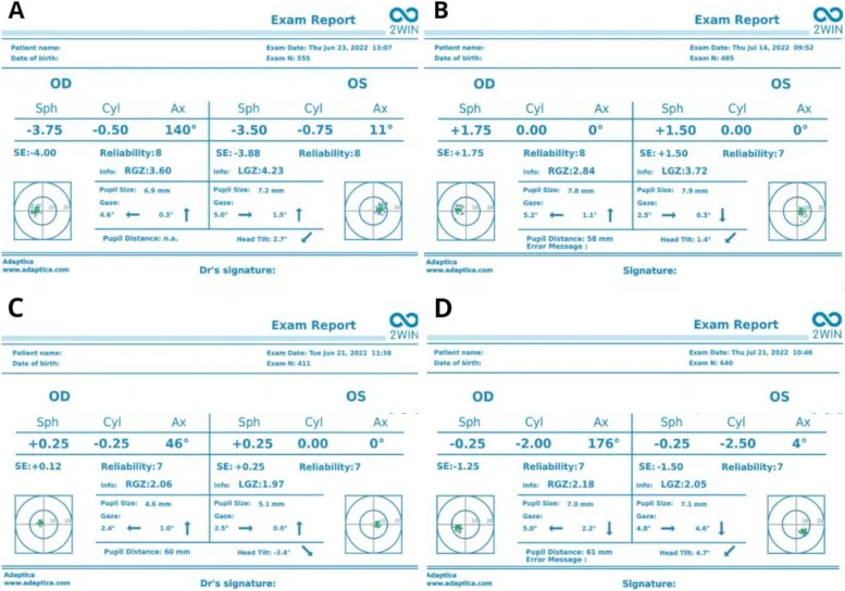 オートレフラクトメータの検査レポート（OD・OS の球面度数・円柱度数・軸・等価球面度数を表示）