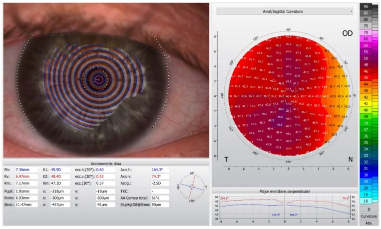 乱視眼におけるOculus Keratograph 5Mによる角膜トポグラフィー：プラシドディスク像（左）と軸方向曲率カラーマップ（右）