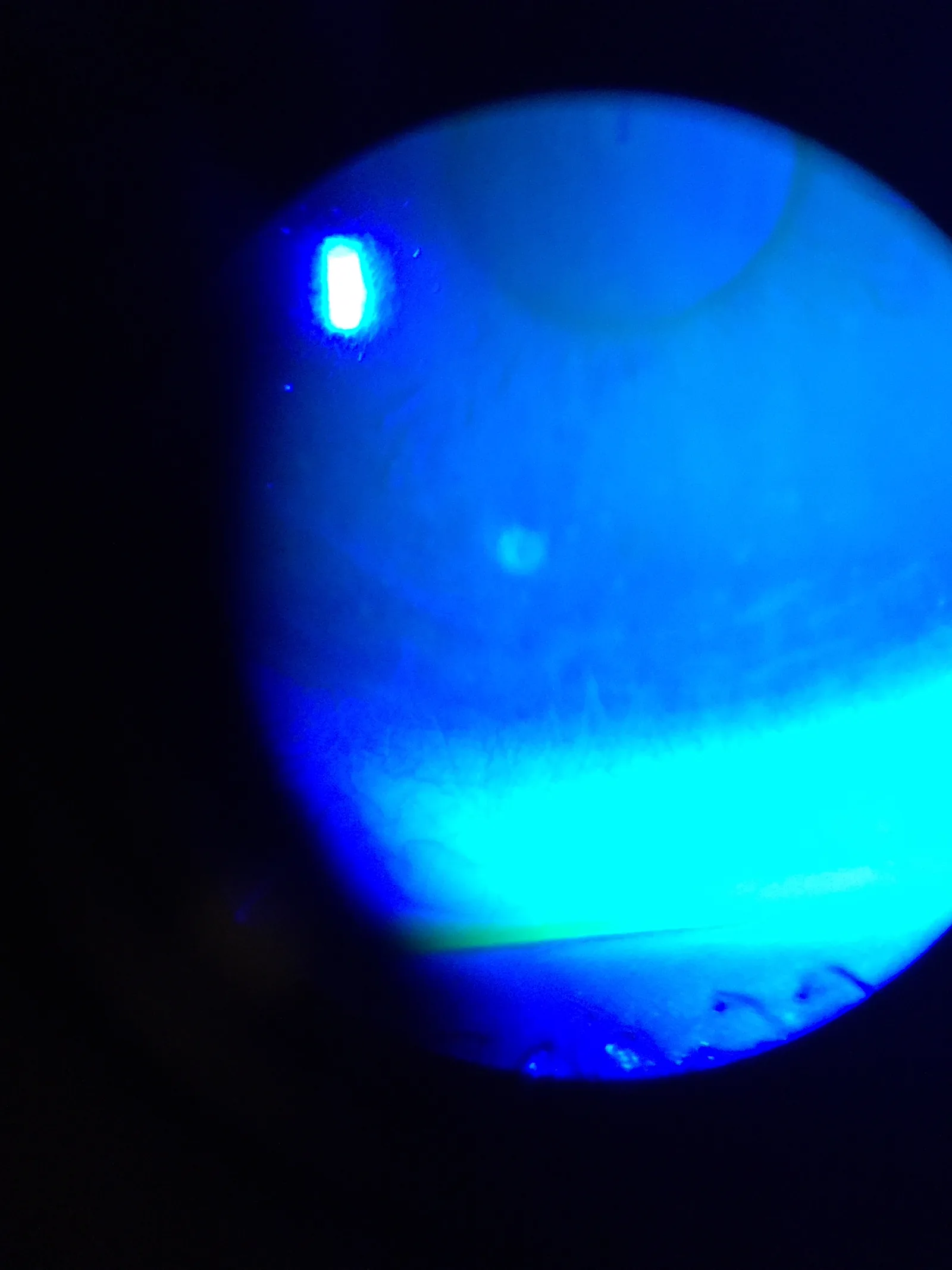 Coloração com fluoresceína sódica de uma pequena úlcera de córnea relacionada ao uso de lentes de contato: a área de defeito epitelial aparece claramente corada em amarelo-esverdeado