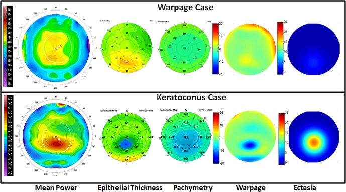 Comparação da topografia corneana (superior) e ceratocone (inferior): mapas topográficos, espessura epitelial, paquimetria, índice de warpage e índice de ectasia