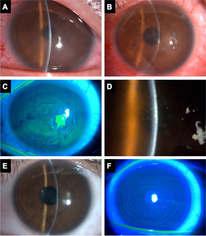 DLK ระยะที่ 3 หลัง LASIK (โรคกระจกตาอักเสบแบบกระจายระหว่างชั้น): การแทรกซึมแบบเม็ดคล้ายทรายทะเลทรายซาฮาราและการหายไปหลังการรักษา