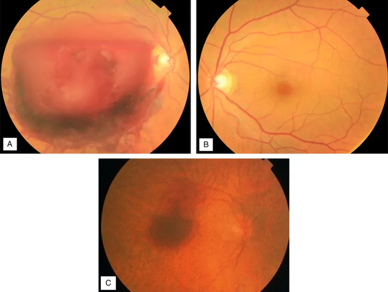 Acquired retinal macroaneurysm の眼底写真