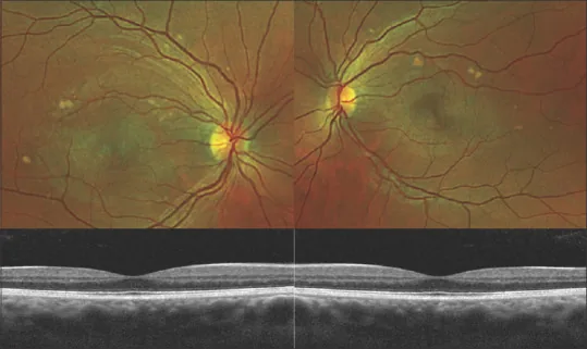 AEPVM の眼底写真と OCT 所見