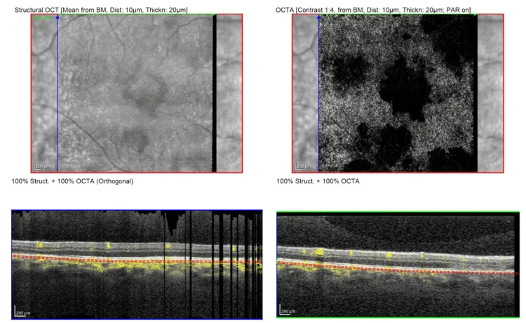 Acute Posterior Multifocal Placoid Pigment Epitheliopathy image