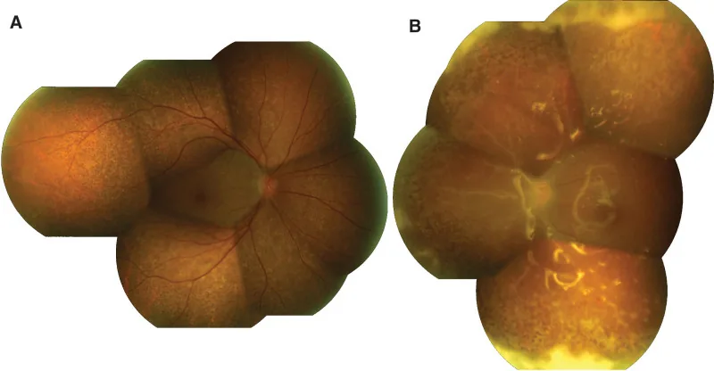 Acute Retinal Necrosis image