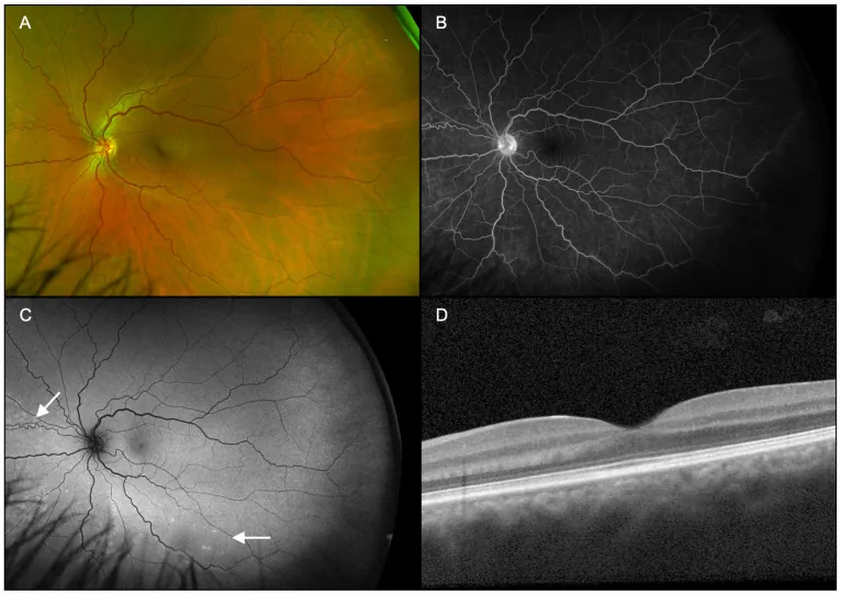Acute Retinal Pigment Epitheliitis image