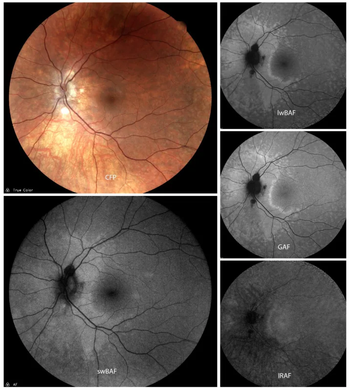 Acute Zonal Occult Outer Retinopathy image