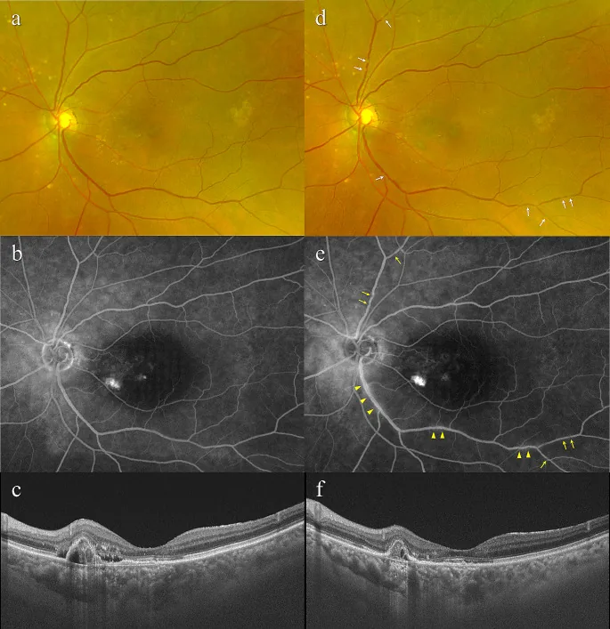 Fundus photograph, fluorescein angiography, and OCT of age-related macular degeneration showing macular RPE changes, PED, and subretinal fluid