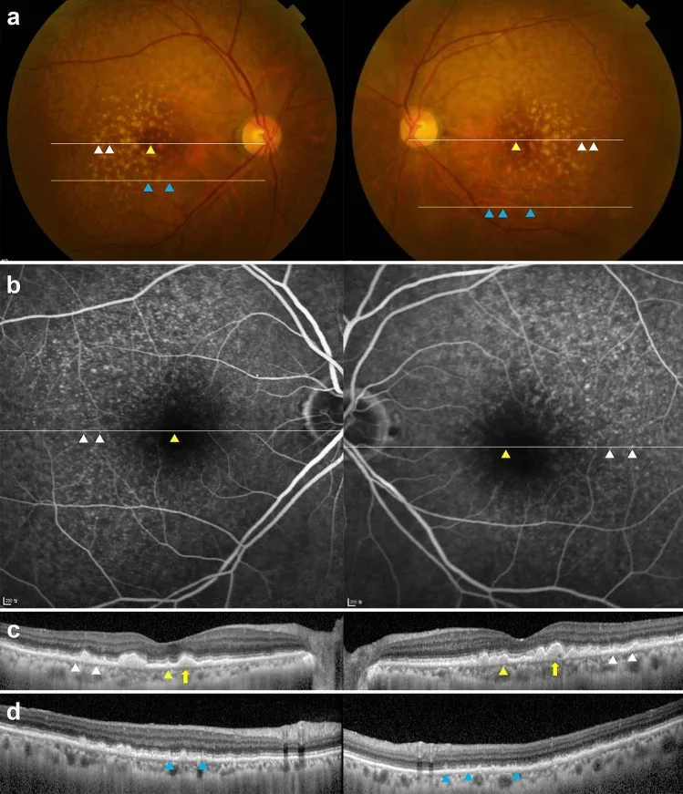 Multimodal images showing drusen, subretinal drusenoid deposits, and sub-RPE deposits seen in AMD