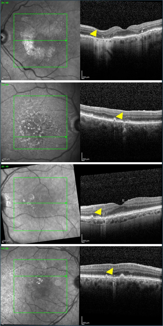 Image showing OCT classification of AMD atrophic lesions: cRORA, iRORA, cORA, and iORA