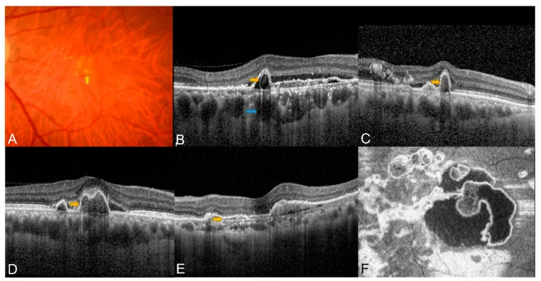 Fundus photograph and OCT of PCV showing orange-red nodules, sub-RPE ring-like lesion, sharp-peaked PED, notched PED, and double-layer sign