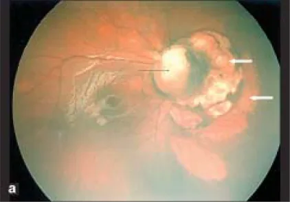 Aicardi Syndrome image